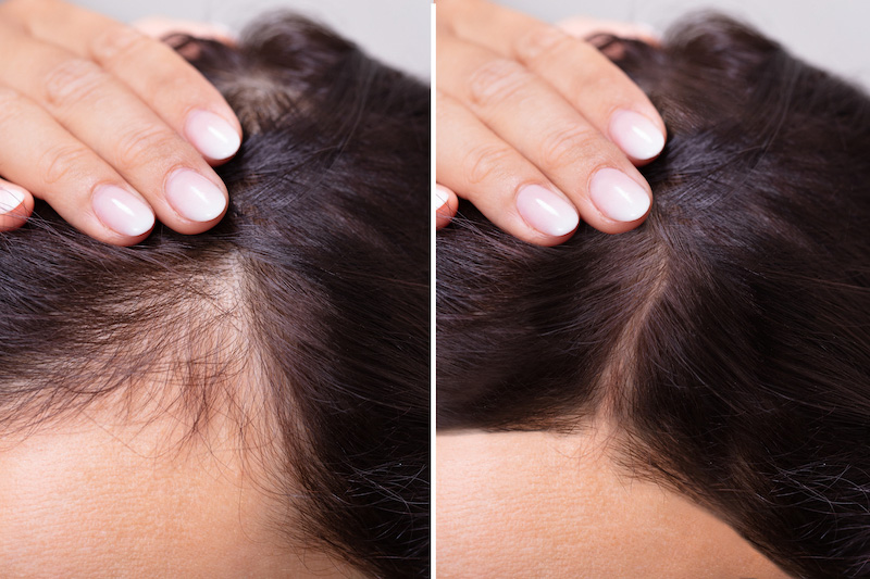 Before and After PRP Hair Treatment