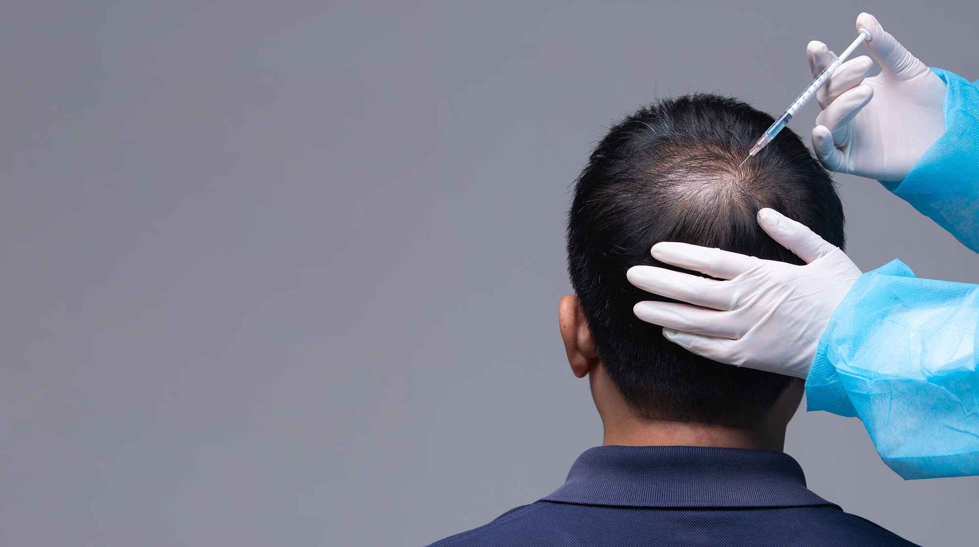 PRP Hair Loss Treatment